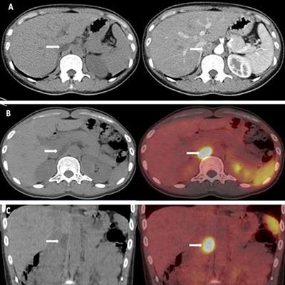 A Rare Aldosterone-Producing Adenoma Detected by 68Ga-pentixafor PET-CT: A Case Report and Literature Review